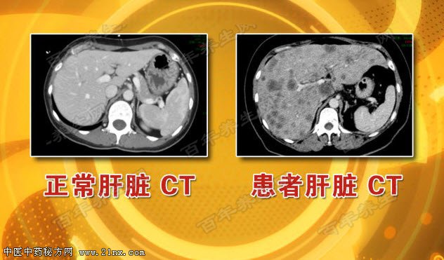 人体肝脏的ct图