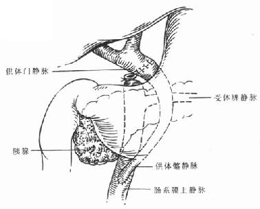 图6-13 门静脉搭桥术