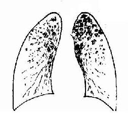 慢性血行播散型肺结核图片